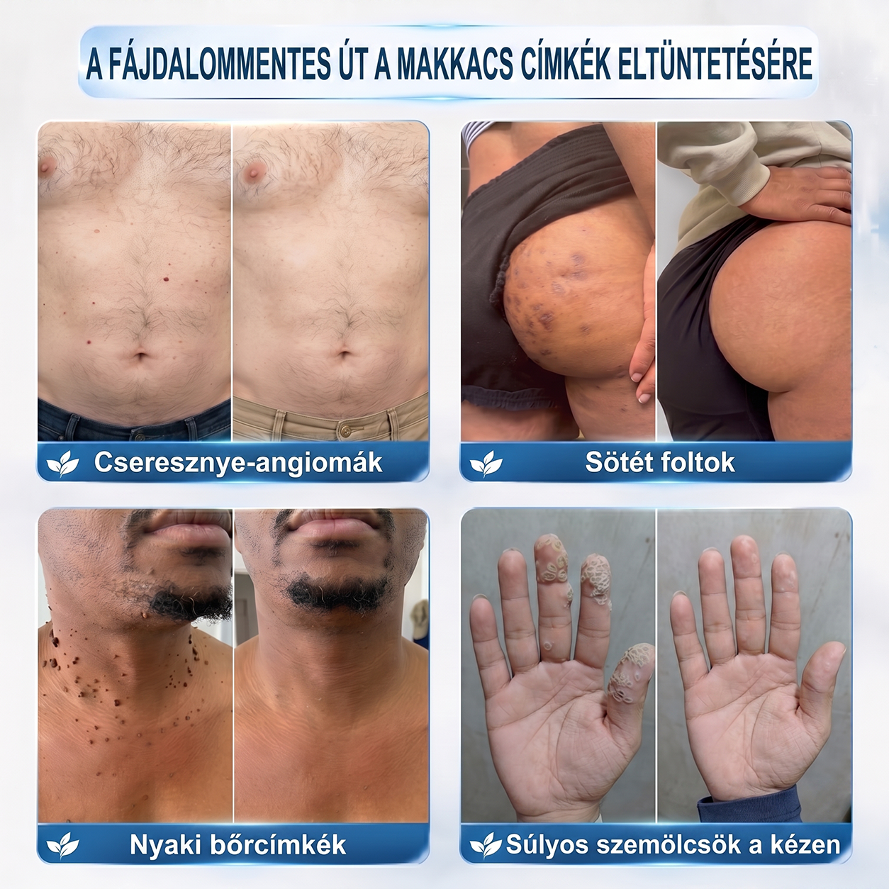 Hivatalos Márkabolt | 🚢🚢 Hiskin® 7 napos Szemölcseltávolító Roll-on Ápoló Folyadék (Fájdalommentes rollerball technológia, hegek nélkül) 🐬